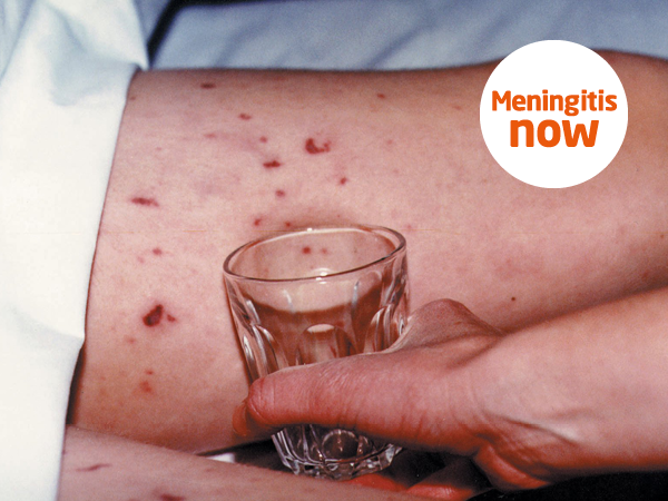 Meningitis Glass Test Meningitis Rash Test Meningitis Now Meningitis Glass Test Meningitis Rash Test Meningitis Now